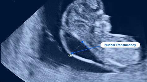 fetal ultrasound showing nuchal translucency measurement
