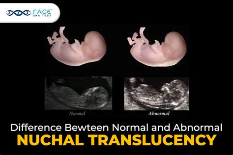 Diagram illustrating how nuchal translucency measurement is taken