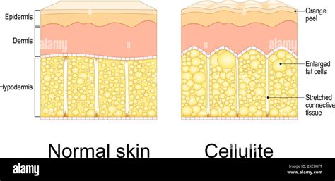 Illustrazione delle fasi della cellulite