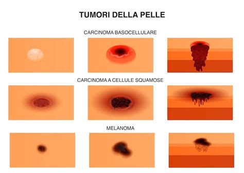 Tipi di tumori che possono produrre hCG