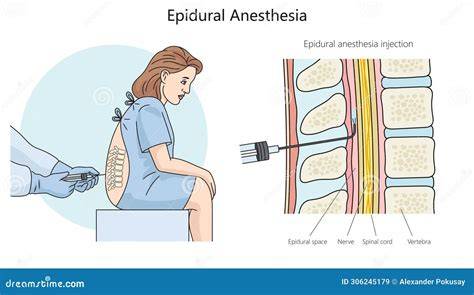 Illustrazione di una persona in posizione fetale per l'anestesia epidurale