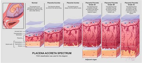 rappresentazione grafica della placenta accreta