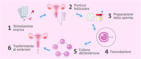 Diagramma che illustra le fasi della fecondazione in vitro (FIVET)
