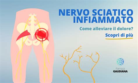 Diagramma che illustra il nervo sciatico e la potenziale lesione