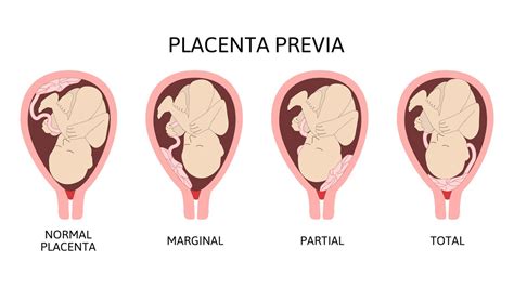 Comparazione placenta previa centrale, marginale, laterale