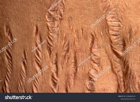 Microscopic view of skin with and without stretch marks