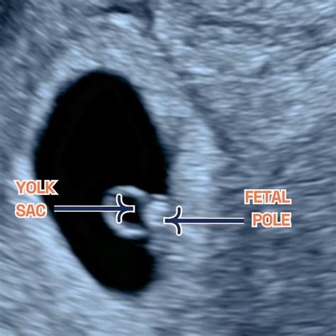 Early pregnancy ultrasound with gestational sac and yolk sac