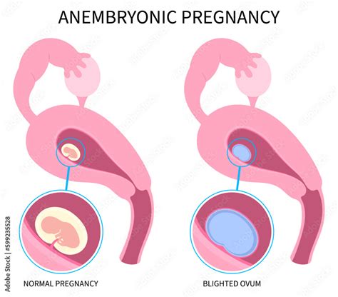 Diagram of a blighted ovum (anembryonic pregnancy)