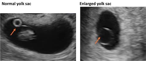 Comparison of normal and abnormal yolk sacs on ultrasound