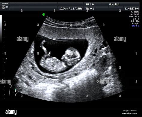 Fetus at 12 weeks ultrasound