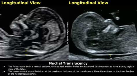 Nuchal translucency measurement