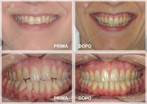 Schema di allineamento dentale con Invisalign