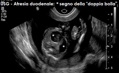 Ecografia con segno della doppia bolla