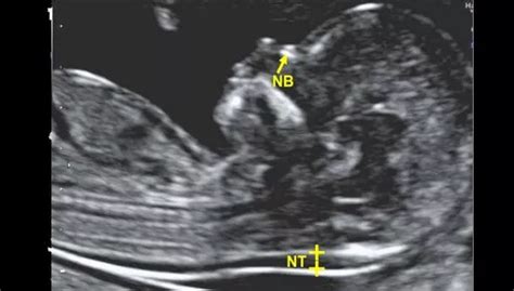 Diagramma della translucenza nucale fetale