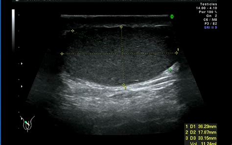Ecografia testicolare con evidenza di varicocele