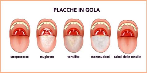 Illustrazione delle tre malattie: difterite (gola infiammata), tetano (persona con spasmi muscolari), pertosse (bambino che tossisce con fatica)