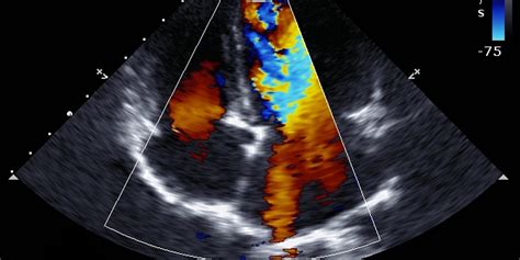 illustrazione di flussimetria doppler in gravidanza