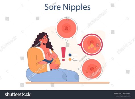Illustration of cracked nipple (ragadi al seno)