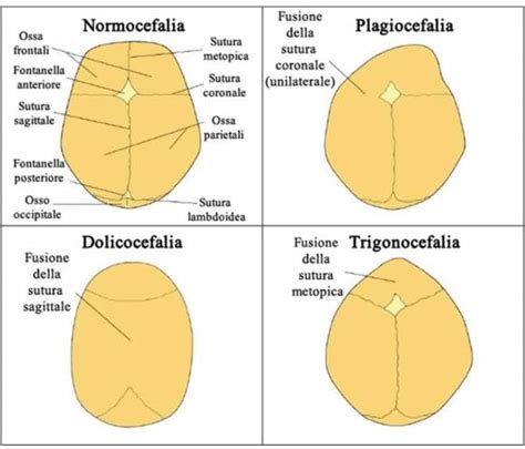 Rappresentazione delle forme craniche tipiche della craniostenosi
