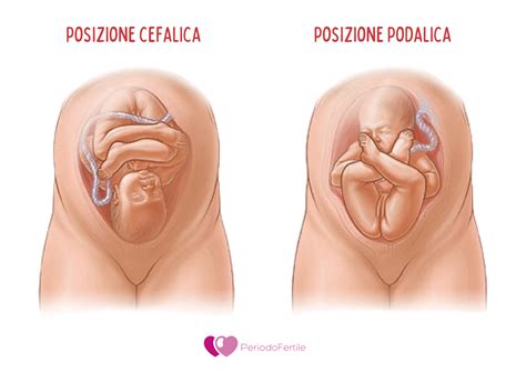 Ecografia fetale che mostra la posizione podalica del bambino
