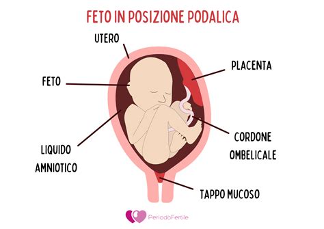 Illustrazione schematica delle fasi di un parto podalico assistito