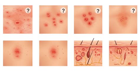 Reazioni allergiche cutanee
