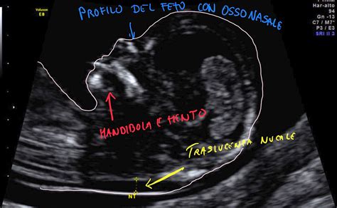 Ecografia del primo trimestre per la misurazione della translucenza nucale (NT)