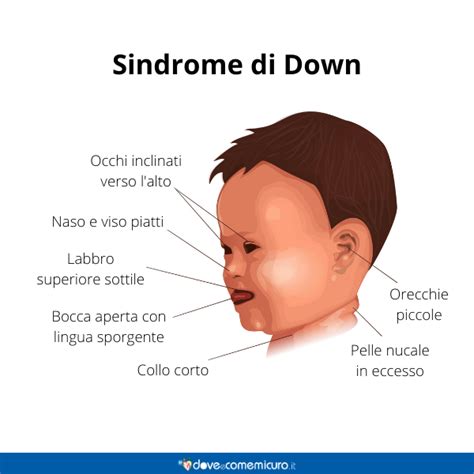 Illustrazione dei tratti facciali distintivi della sindrome di Down