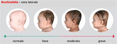 schema grafico a confronto: plagiocefalia, brachicefalia e dolicocefalia