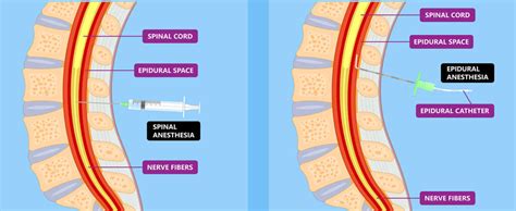 Complicanze associate all'anestesia epidurale e spinale