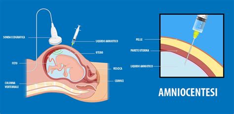 rappresentazione schematica dell'amniocentesi e del prelievo del liquido amniotico