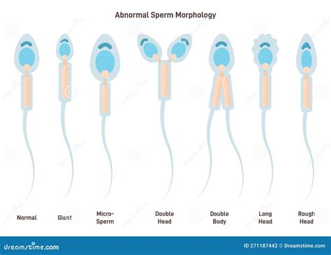 diagramma comparativo tra morfologia normale e anomalie degli spermatozoi