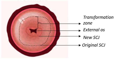 Cervix uterina con aree di prelievo