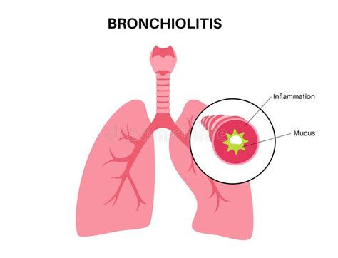 Illustrazione delle vie aeree infiammate nella bronchiolite