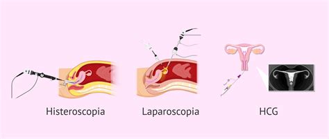 Diagramma comparativo: HSG vs. Isterosonografia vs. Laparoscopia