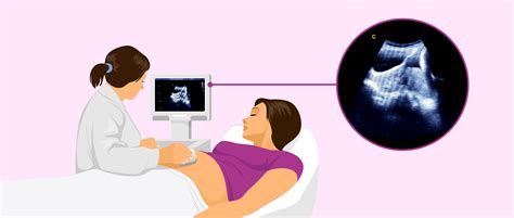 Ecografia che mostra la placenta previa