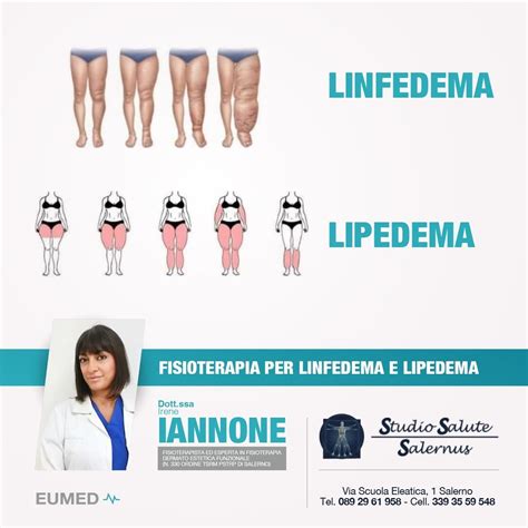 infografica sulle tecniche di gestione del linfedema: massaggi, bendaggi, esercizi, indumenti compressivi