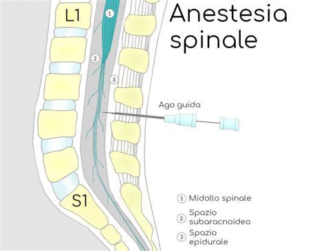 Schema dell'anatomia spinale e punto di iniezione dell'epidurale