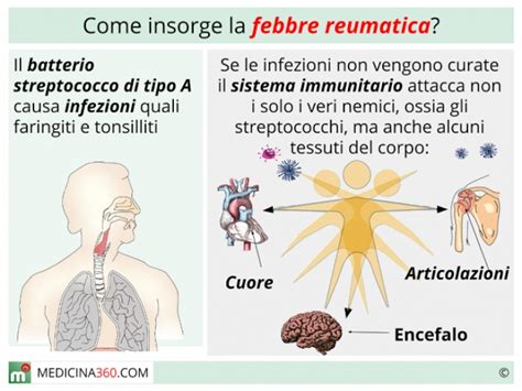 Infografica che mostra le diverse fasi della diagnosi della febbre reumatica acuta