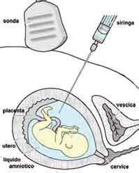 schema anatomico dell'amniocentesi