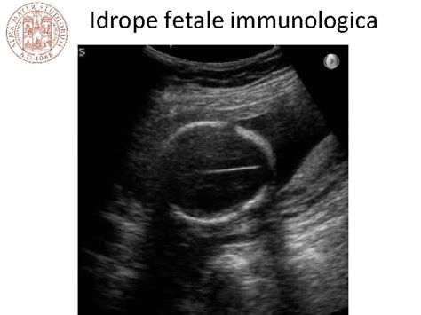 Cause dell'idrope fetale non immunologica
