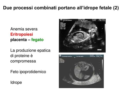 Ecografia di idrope fetale