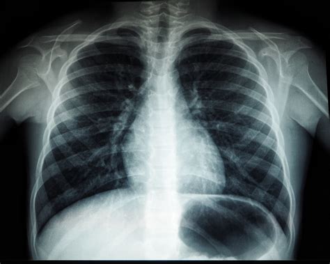 radiografia del torace di un neonato che mostra opacità polmonari tipiche della SAM