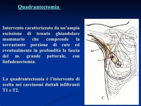 Differenza tra mastectomia e chirurgia conservativa