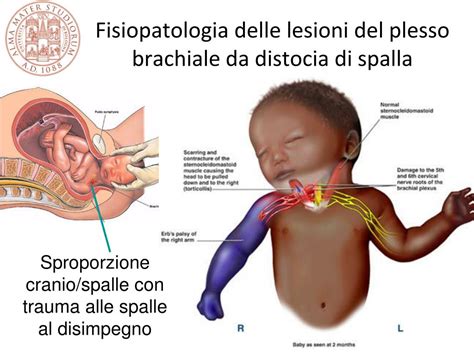 Illustrazione della distocia di spalla