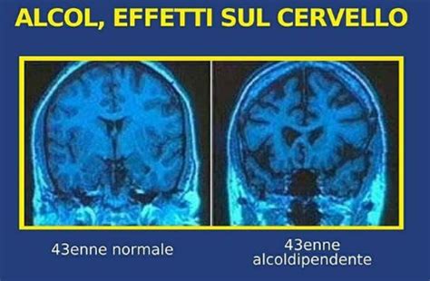 Danni dell'ittero non trattato al cervello