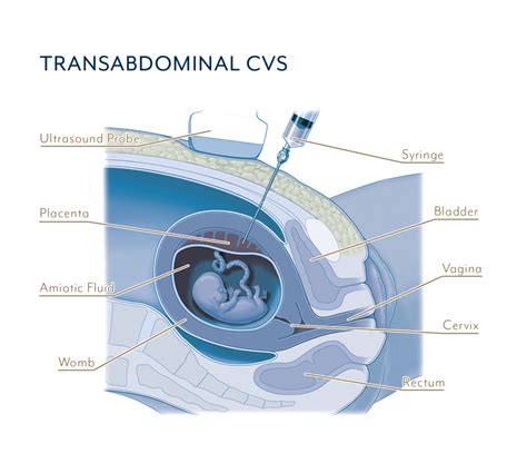 Diagram showing the transabdominal villocentesis procedure with ultrasound guidance