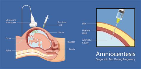 Comparative chart: Villocentesis vs. Amniocentesis (timing, diagnostic scope, main risks)