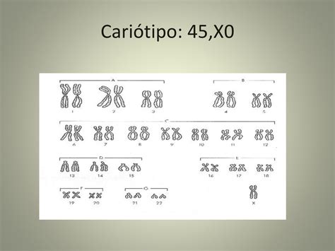 Cariotipo 45,X0