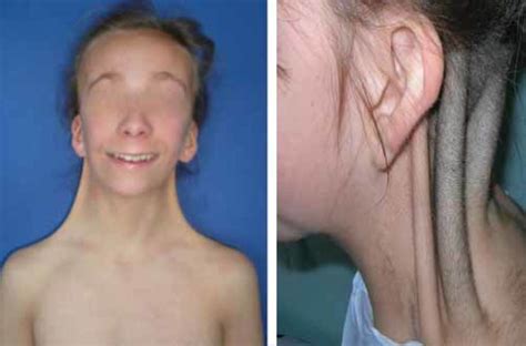 Collo palmato in sindrome di Turner